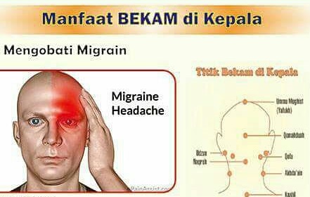 Bekam mengobati migrain dan sakit kepala, perhatikan titik bekam di kepala. (foto: ist/palontaraq)