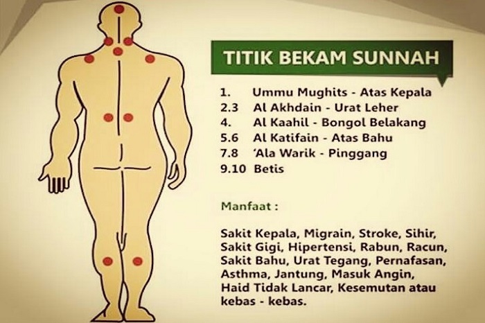 Titik bekam sunnah. (foto: ist/palontaraq)